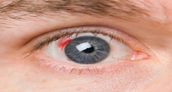 blood clots forming in the eyes