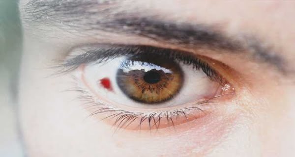 blood clots forming in the eyes