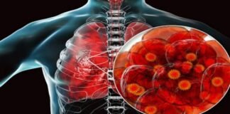 Lungs destroyed by coronavirus attack