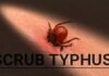 Scrub typhus