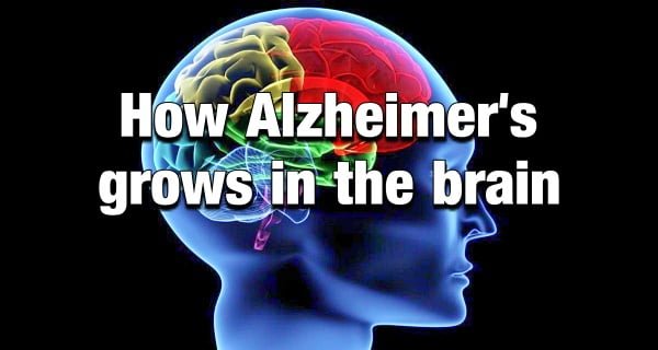 Alzheimer