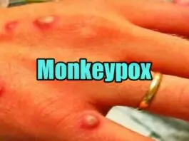 monkeypox