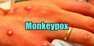 monkeypox