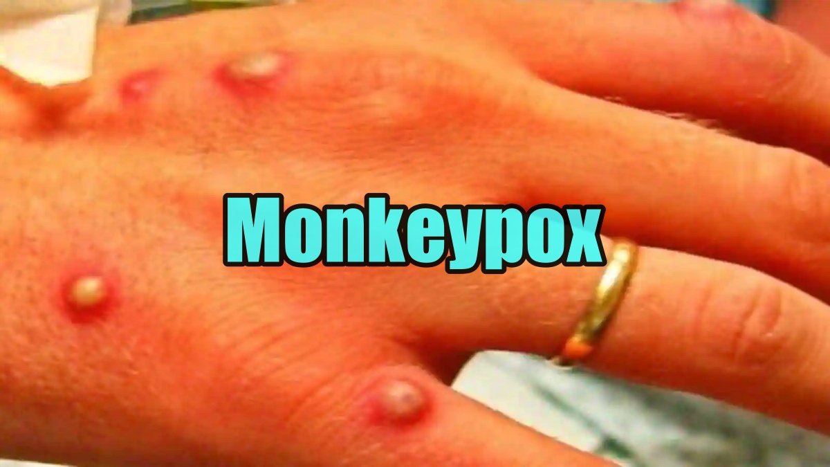 Monkeypox panic in many countries; symptoms and how does this disease spread?