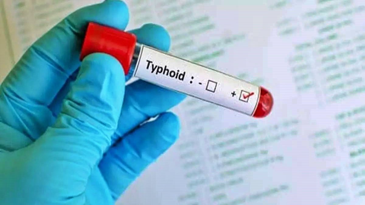 Typhoid will no longer be cured easily, bacteria become strong against antibiotics