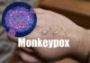 monkeypox