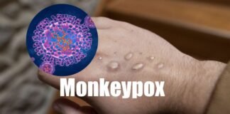 monkeypox