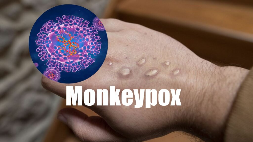 monkeypox