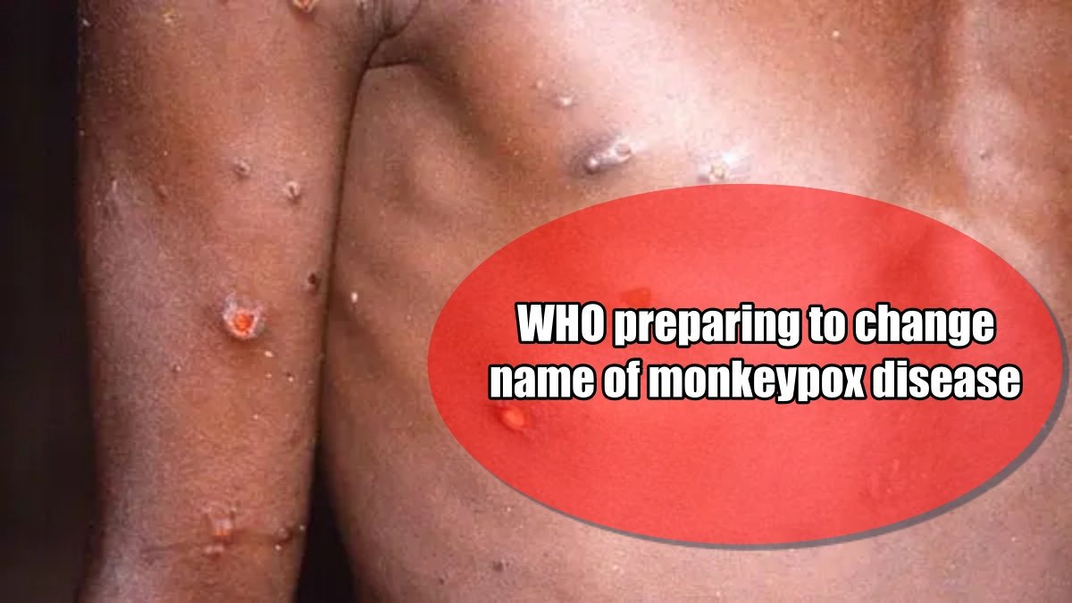 WHO preparing to change name of monkeypox disease, this is the reason