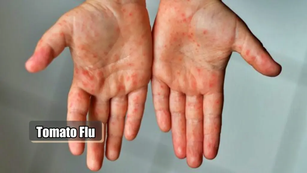 tomato flu | PalPal News Hub | Latest National, Technology, and Astrology News tomato flu
