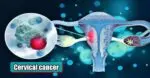 Government should start national mission on Cervical cancer, lives can be saved due to introduction of 5G technology Cervical cancer