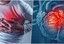 heart attack