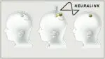 Elon Musk’s Neuralink makes history with first human brain implant Neuralink