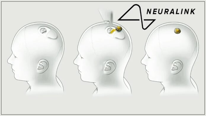 Neuralink