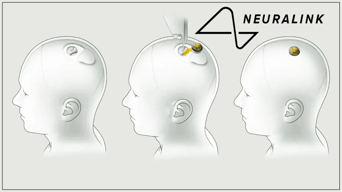 Elon Musk’s Neuralink makes history with first human brain implant