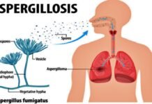 Aspergillus fumigatus