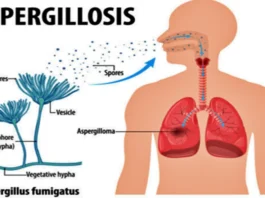 Aspergillus fumigatus